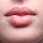 Nguyên nhân xuất hiện sẹo lồi ở môi là gì?