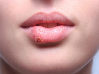 Nguyên nhân xuất hiện sẹo lồi ở môi là gì?