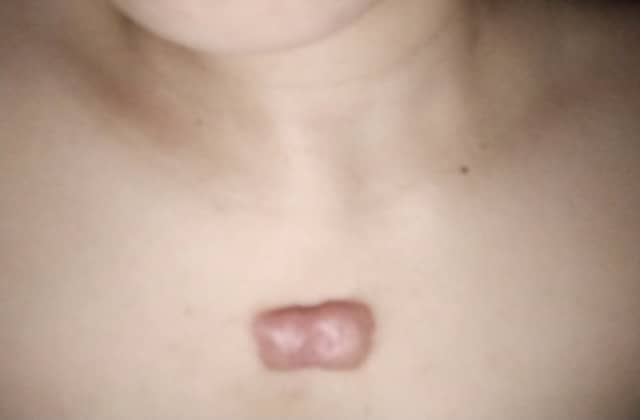 Nguyên nhân khiến sẹo lồi xuất hiện ở ngực