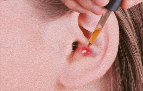 Nguyên nhân gây mụn nhọt ở vành và trong lỗ tai